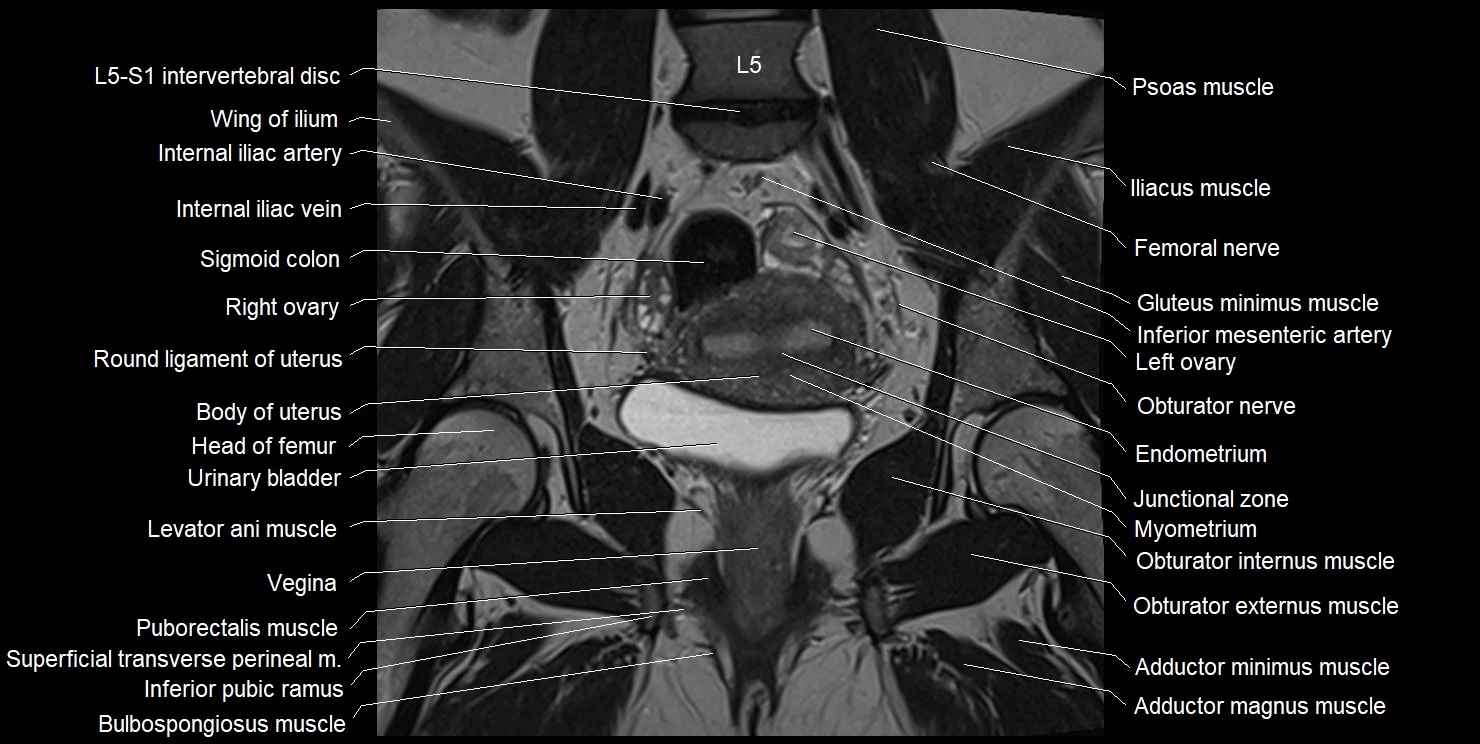 female pelvis coronal cross sectional anatomy image 18.webp